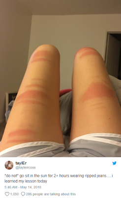 Να τι μπορεί να συμβεί στο δέρμα σου αν φοράς σκισμένο τζιν και κάθεσαι στον ήλιο - Φωτογραφία 3