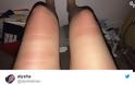 Να τι μπορεί να συμβεί στο δέρμα σου αν φοράς σκισμένο τζιν και κάθεσαι στον ήλιο - Φωτογραφία 4