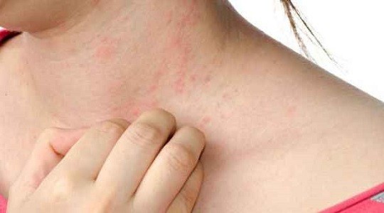 Παγκόσμια Ημέρα Αλλεργίας: Η αλλεργία αποτελεί τη μεγαλύτερη απειλή για το δέρμα μας - Φωτογραφία 1