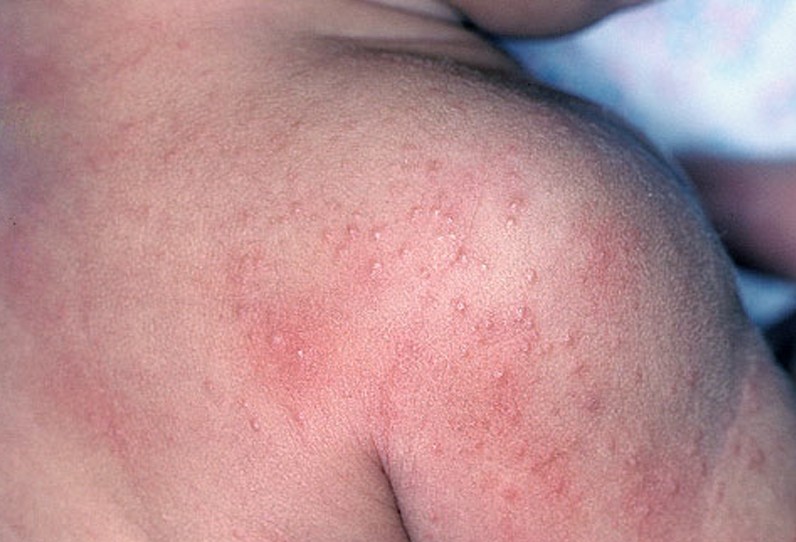 Αλλεργίες και αλλεργικό εξάνθημα του καλοκαιριού. Που οφείλονται και πώς αντιμετωπίζονται; - Φωτογραφία 2