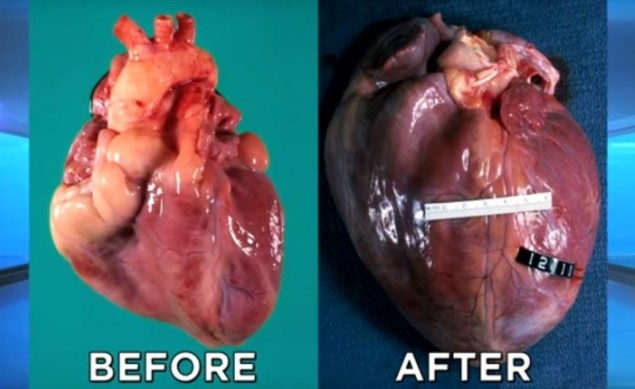 Πώς γίνεται η καρδιά μετά από μακροχρόνια χρήση κοκαΐνης - Φωτογραφία 1