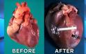 Πώς γίνεται η καρδιά μετά από μακροχρόνια χρήση κοκαΐνης