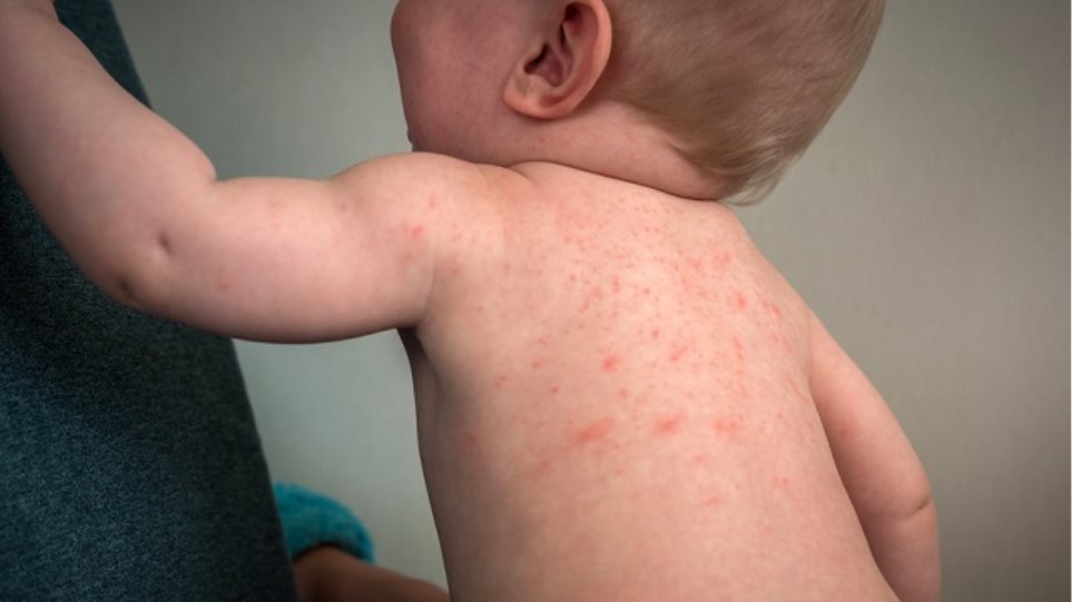 Αλλεργίες: Ένας αόρατος εχθρός του δέρματος - Φωτογραφία 1