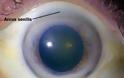 Υψηλή χοληστερίνη: Το σημάδι στα μάτια που δείχνει ανεβασμένη χοληστερόλη - Φωτογραφία 2