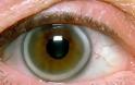 Υψηλή χοληστερίνη: Το σημάδι στα μάτια που δείχνει ανεβασμένη χοληστερόλη - Φωτογραφία 3