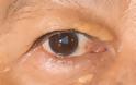 Υψηλή χοληστερίνη: Το σημάδι στα μάτια που δείχνει ανεβασμένη χοληστερόλη - Φωτογραφία 4