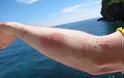 Τσίμπημα από τσούχτρα στην θάλασσα: Τι πρέπει να κάνετε - Φωτογραφία 2