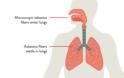 Τι είναι ο αμίαντος και πώς συνδέεται με τον καρκίνο η εισπνοή σκόνης αμιάντου; Γιατί κινδυνεύουν κάτοικοι και διασώστες στο Μάτι; - Φωτογραφία 3