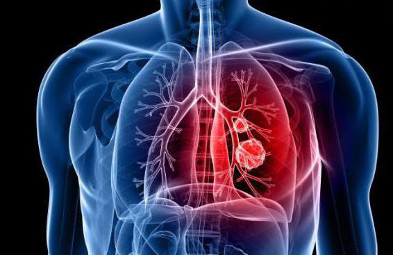 Τι είναι ο αμίαντος και πώς συνδέεται με τον καρκίνο η εισπνοή σκόνης αμιάντου; Γιατί κινδυνεύουν κάτοικοι και διασώστες στο Μάτι; - Φωτογραφία 1