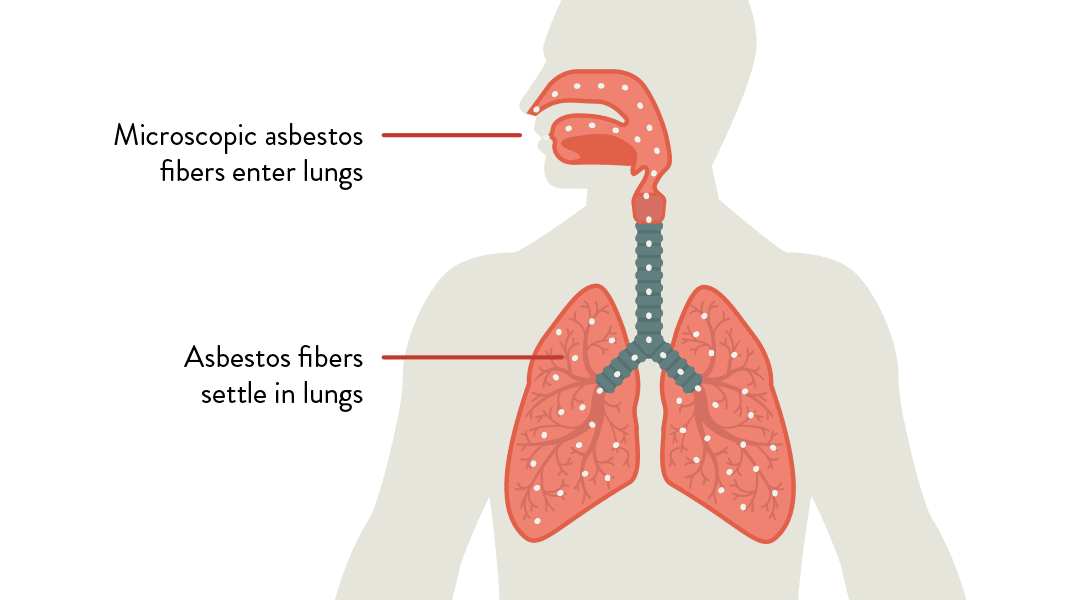 Τι είναι ο αμίαντος και πώς συνδέεται με τον καρκίνο η εισπνοή σκόνης αμιάντου; Γιατί κινδυνεύουν κάτοικοι και διασώστες στο Μάτι; - Φωτογραφία 3