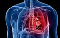 Τι είναι ο αμίαντος και πώς συνδέεται με τον καρκίνο η εισπνοή σκόνης αμιάντου; Γιατί κινδυνεύουν κάτοικοι και διασώστες στο Μάτι;
