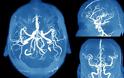Ανεύρυσμα εγκεφάλου: Τα συμπτώματα SOS που πρέπει να γνωρίζετε