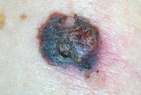 Μελάνωμα, ο χειρότερος καρκίνος του δέρματος. Ποιοι κινδυνεύουν; Πώς γίνεται αντιληπτό; - Φωτογραφία 2