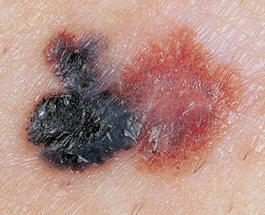 Μελάνωμα, ο χειρότερος καρκίνος του δέρματος. Ποιοι κινδυνεύουν; Πώς γίνεται αντιληπτό; - Φωτογραφία 3