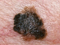 Μελάνωμα, ο χειρότερος καρκίνος του δέρματος. Ποιοι κινδυνεύουν; Πώς γίνεται αντιληπτό; - Φωτογραφία 4
