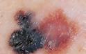 Μελάνωμα, ο χειρότερος καρκίνος του δέρματος. Ποιοι κινδυνεύουν; Πώς γίνεται αντιληπτό; - Φωτογραφία 3