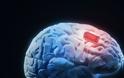 Εμφύτευμα στον εγκέφαλο μπορεί να θεραπεύσει επιληπτικές κρίσεις;