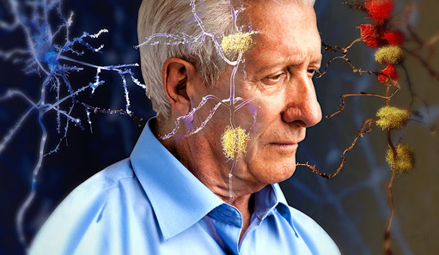 Φάρμακο για την ηπατική νόσο ενδεχομένως δρα θετικά έναντι του Αλτσχάιμερ, σύμφωνα με νέα μελέτη - Φωτογραφία 1