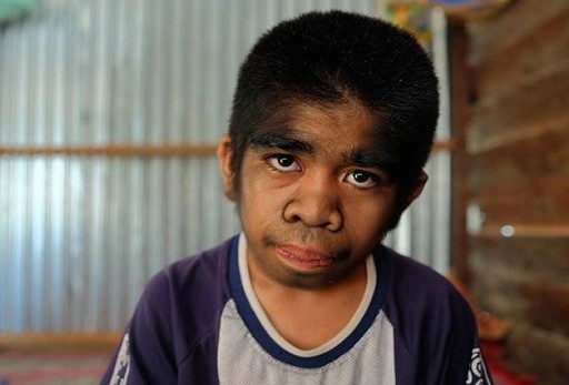 ΣΟΚΑΡΙΣΤΙΚΟ: Ο 13χρονος λυκάνθρωπος που λατρεύεται σαν Θεός - Αρνείται οποιαδήποτε θεραπεία γιατί θεωρεί τον εαυτό του... [photos] - Φωτογραφία 1