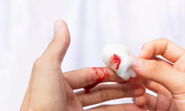 Πώς θα σταματήσετε την αιμορραγία με υλικά που έχετε στο σπίτι σας; - Φωτογραφία 1
