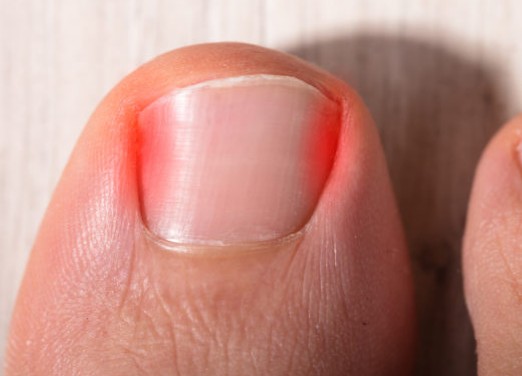 Νύχι που μπαίνει στο δέρμα: Τα σωστά βήματα αντιμετώπισης - Φωτογραφία 1