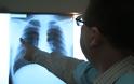 Καρκίνος του πνεύμονα: Επανάσταση στην αντιμετώπισή του έφερε η ανοσοθεραπεία με τα νεότερα φάρμακα - Φωτογραφία 1