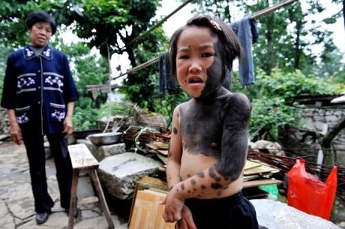 Συγκλονιστική ιστορία: Το κοριτσάκι με το σύνδρομο του λύκου - Φωτογραφία 2