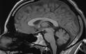 Πόρτλαντ: Γιατροί αφαίρεσαν όγκο στον εγκέφαλο 14χρονου από τη μύτη