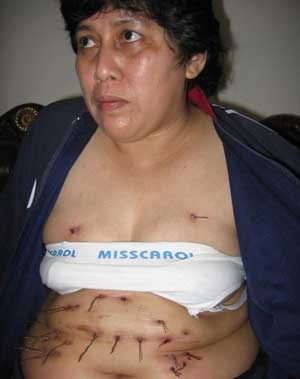 Γυναίκα βγάζει από το σώμα της μεταλλικές τρίχες - Φωτογραφία 2