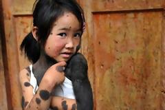 6χρονο κοριτσάκι μισή άνθρωπος – μισή λύκος [Φώτος]