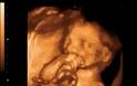 Δείτε το πρώτο υπερηχογράφημα εμβρύου σε 3D