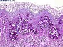 Νόσος Paget, μια σπάνια μορφή καρκίνου μαστού - Φωτογραφία 1