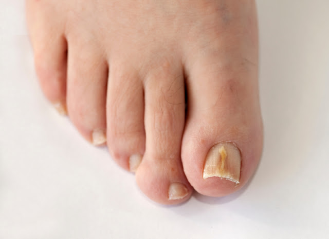 Τι μπορεί να αποκαλύψει το χρώμα των νυχιών στα πόδια μας για την υγεία μας; - Φωτογραφία 2