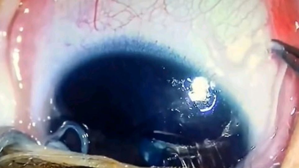 Γιατροί έβγαλαν 11 σκουλήκια από το μάτι βρέφους - Φωτογραφία 1