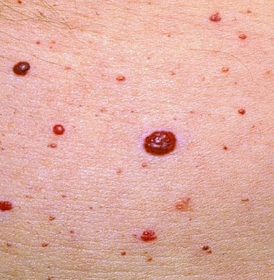 Kόκκινες ελιές στο δέρμα (κερασοειδή αιμαγγειώματα). Είναι επικίνδυνες και πώς αντιμετωπίζονται; - Φωτογραφία 1