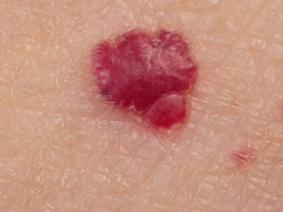 Kόκκινες ελιές στο δέρμα (κερασοειδή αιμαγγειώματα). Είναι επικίνδυνες και πώς αντιμετωπίζονται; - Φωτογραφία 2