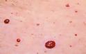 Kόκκινες ελιές στο δέρμα (κερασοειδή αιμαγγειώματα). Είναι επικίνδυνες και πώς αντιμετωπίζονται;