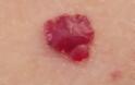 Kόκκινες ελιές στο δέρμα (κερασοειδή αιμαγγειώματα). Είναι επικίνδυνες και πώς αντιμετωπίζονται; - Φωτογραφία 2