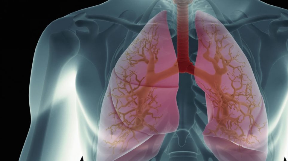 Μεταμόσχευσαν σε γυναίκα πνεύμονες καπνίστριας και πέθανε από καρκίνο - Φωτογραφία 1