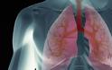 Μεταμόσχευσαν σε γυναίκα πνεύμονες καπνίστριας και πέθανε από καρκίνο