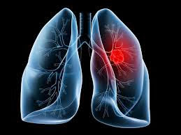 Προσοχή, ο καρκίνος του πνεύμονα συχνά ΔΕΝ παρουσιάζει συμπτώματα. Αποτελεί την τρίτη συχνότερη μορφή καρκίνου - Φωτογραφία 2