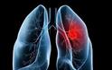 Προσοχή, ο καρκίνος του πνεύμονα συχνά ΔΕΝ παρουσιάζει συμπτώματα. Αποτελεί την τρίτη συχνότερη μορφή καρκίνου - Φωτογραφία 2