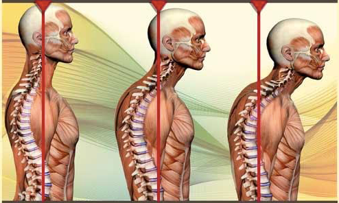 «Text neck»: Τι είναι και με ποια συμπτώματα εκδηλώνεται; Πώς θα το αντιμετωπίσετε; - Φωτογραφία 3