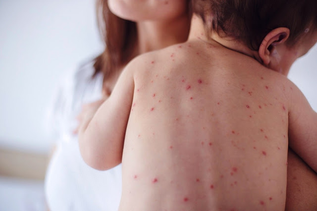 Σε υψηλό 20ετίας τα κρούσματα ιλαράς στην Ευρώπη λόγω του αντιεμβολιαστικού κινήματος - Φωτογραφία 1
