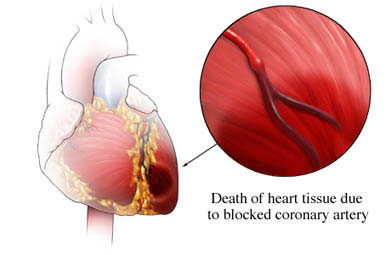Θωρακικός Πόνος, πόνος στο στήθος, στηθάγχη. Τι άλλο εκτός από καρδιά; Συμπτώματα καρδιακής προσβολής - Φωτογραφία 2