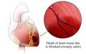 Θωρακικός Πόνος, πόνος στο στήθος, στηθάγχη. Τι άλλο εκτός από καρδιά; Συμπτώματα καρδιακής προσβολής - Φωτογραφία 2