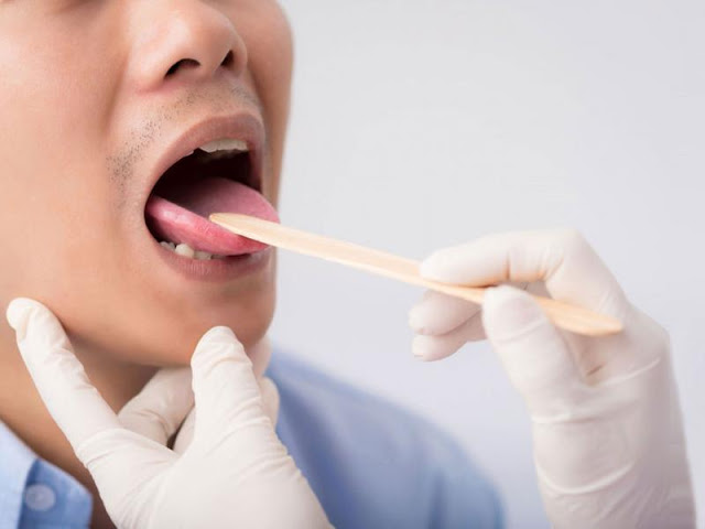 Καρκίνος του στόματος: Ανησυχία προκαλεί στους επιστήμονες η αύξηση των κρουσμάτων - Φωτογραφία 3