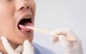 Καρκίνος του στόματος: Ανησυχία προκαλεί στους επιστήμονες η αύξηση των κρουσμάτων - Φωτογραφία 3