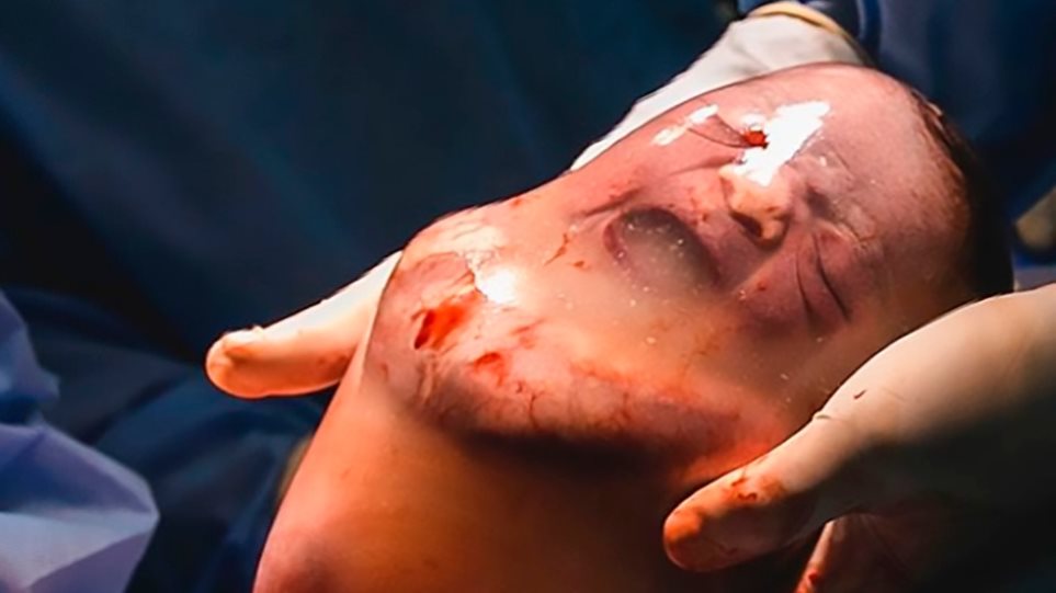 Φωτογραφίες-σοκ: Μωρό γεννήθηκε μέσα στον αμνιακό σάκο - Φωτογραφία 1
