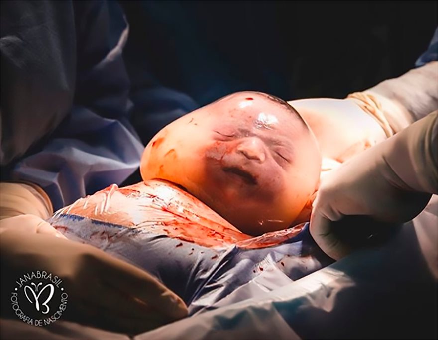 Φωτογραφίες-σοκ: Μωρό γεννήθηκε μέσα στον αμνιακό σάκο - Φωτογραφία 3